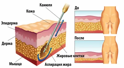 Липосакция подбородка: цены, фото до и после липосакции, отзывы - МедЛаз