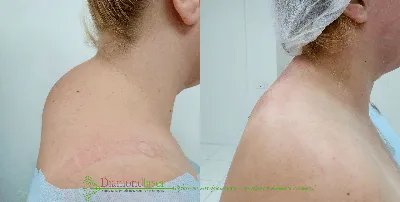 Процедуры инъекции липолитиков от 1990 руб/мл - BeautyWay Clinic 8 (499)  393-36-16