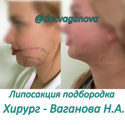 Галерея До и После - Arte Clinic, эстетическая хирургия Брно