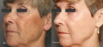 Лазерная шлифовка кожи лица, вокруг глаз, шрамов, рубцов – цены, отзывы о  процедуре