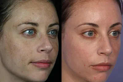 Фотографии до и после лазерной шлифовки лица Acupulse, проводим в клинике  Premium Aesthetics