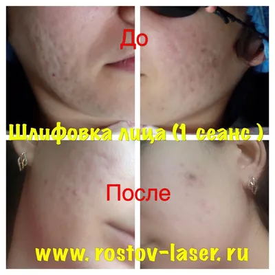 Лазерная шлифовка лица в Москве, цены на услуги, сколько стоит лазерная  шлифовка кожи в клинике «ДОКТОРПЛАСТИК»