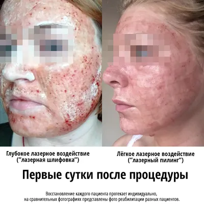 Лазерная шлифовка кожи лица: цена в Новосибирске