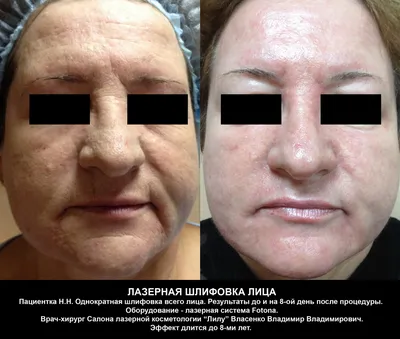 До и после процедуры лазерной шлифовки кожи лица MOSAIC — MLC