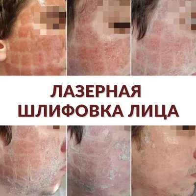 Фотографии до и после лазерной шлифовки лица Acupulse, проводим в клинике  Premium Aesthetics