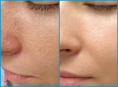 Лазерная шлифовка лица: фото до и после, отзывы специалистов, как проходит  процедура