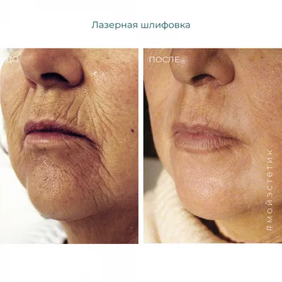 Косметология City Clinic. Иркутск - Лазерная шлифовка век. На дворе уже  октябрь🍂, а это значит, что наступает время лазерных шлифовок. Сохранить  красоту и молодость можно без хирургического вмешательства. Лазерная  шлифовка — неинвазивный👌