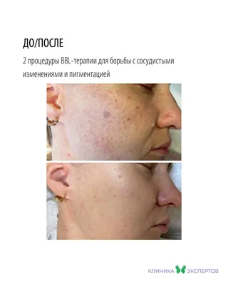 Лазерная шлифовка кожи лица, рубцов, шрамов, цены в Москве