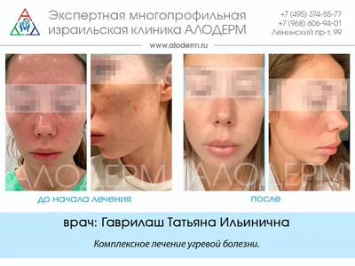 Лечение акне - клиника лазерной косметологии в Москве