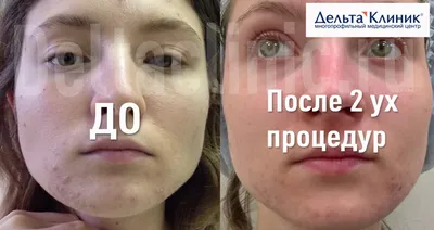 Лечение акне (угрей) в Киеве | Brenner Clinic
