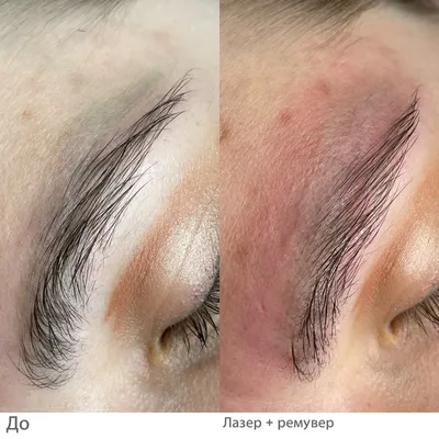 Лазерное удаление татуажа, перманентного макияжа в Донецке, Макеевке