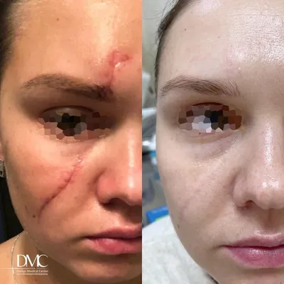 Фото до и после лазерной косметологии | Клиника Damas Clinic на Таганской