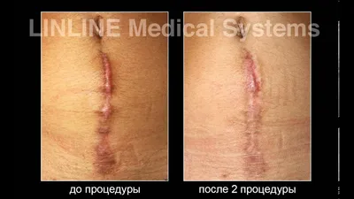 Удаление рубцов, шрамов | Клиника доктора Куприна