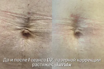 Лазерное лечение шрамов, рубцов, растяжек в Нижнем Новгороде | «Андромеда»