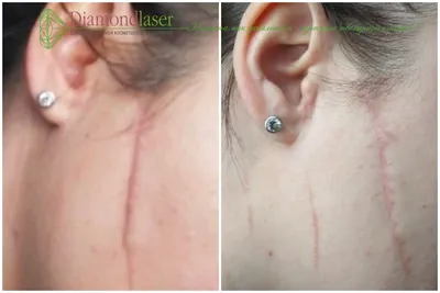 Лазерное удаление шрамов и рубцов в Киеве - клиника Diamond Laser