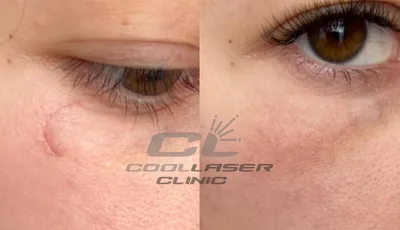 Лазерное удаление шрамов на лице в Киеве, шлифовка Coolaser Clinic