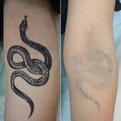 Удаление татуировок лазером фото до и после, примеры работ сведения тату в  студии Натальи Еселевич в Москве, Новосибирске