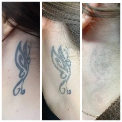 Лазерное удаление тату и татуажа. Как выбрать специалиста? | MKNK Laser - Удаление  тату и татуажа во Владивостоке | Дзен
