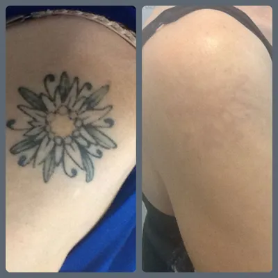 Удаление татуировки лазером | Доктор Марина Гогина