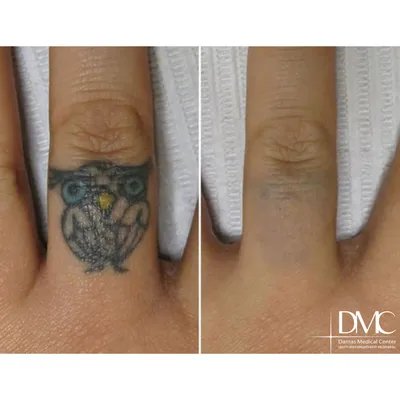 Фото удаления татуировки (тату) и перманентного макияжа до и после