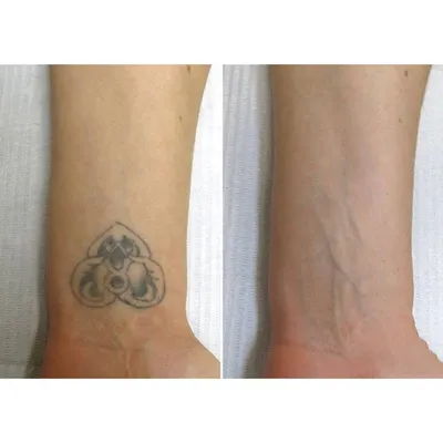 Лазерное удаление татуировок: фото до и после - цены в Спб