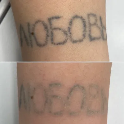 Удаление татуировок и татуажа в Новосибирске. Лазерное удаление татуажа и  татуировок по цене от 1500 руб.