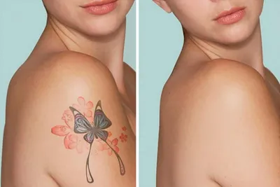 Лазерное удаление татуировок в Нижнем Новгороде по оптимальным ценам |  Стоимость удаления татуировок лазером