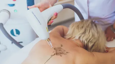 ᐉ Удаление тату и татуажа в Киеве ᐉ Цены на лазерное выведение татуировок,  отзывы о лазерном удалении татуажа