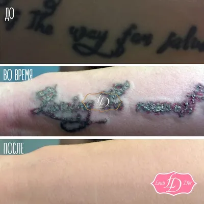 Удаление татуировок лазером без шрамов в Москве, цена от 1000 руб/сеанс
