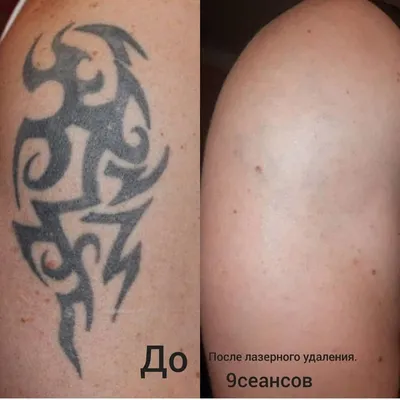 Лазерное удаление татуировок и татуажа