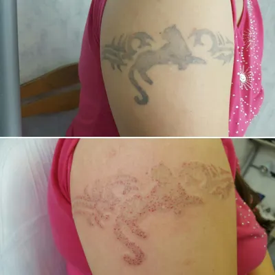 Удаление татуировок лазером в Москве | Сведение татуажа