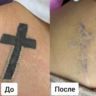 🥇 Удаление татуировок лазером в Алматы: Цена, Отзывы. Лазерное выведение  тату — MLC