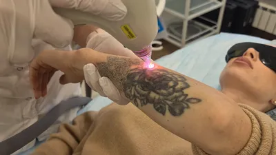 Удаление татуировок (татуажа) — Тату-салон Колибри