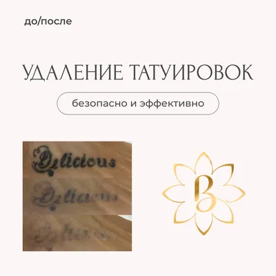 Удаление татуировок лазером в Москве - цены на лазерное удаление татуировок  в клинике Damas Clinic (м. Таганская)