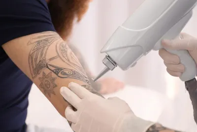 Лазерное удаление татуажа в Москве - цены, запись на прием | Клиника  лазерной косметологии Candela