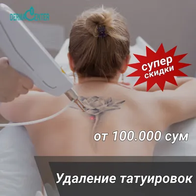 Удаление татуировок - лазер PicoPlus | о процедуре