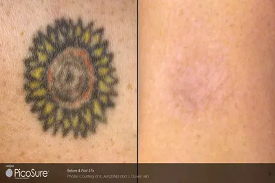 Лазерное удаление татуировки — Umetex Aesthetics