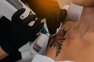 Примеры работ по удалению татуировок - Midgard