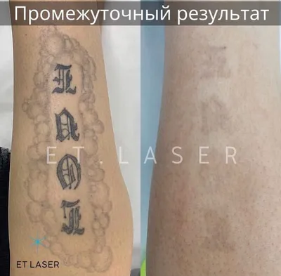 ᐅ Удаление тату и татуажа в Одессе ᐊ Цены и отзывы на лазерное удаление тату  в клинике Аура