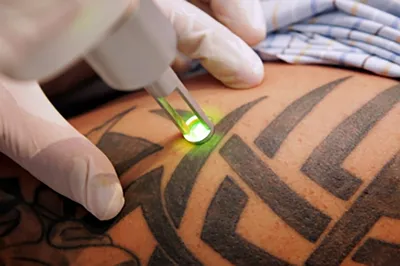 Лазерное удаление татуажа - «Желаете исправить ошибки\"чудо-мастеров\"татуажа?тогда  лазерное удаление для вас!+Фото удаления татуажа бровей.» | отзывы
