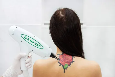 Лазерное удаление татуировок, татуажа - Клиника актуальной косметологии  Рязани