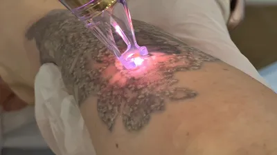 Лазерное удаление татуировок — ФОТО до и после - LINLINE