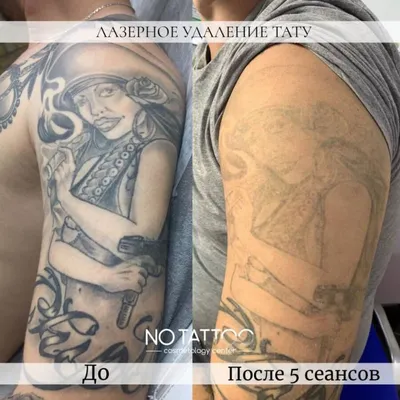 Лазерное удаление тату/татуажа | Facebook