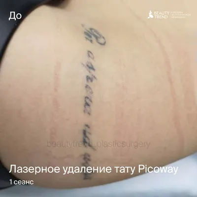 Удаление тату и перманентного макияжа лазером, цена | Вывести татуировку в  Минске