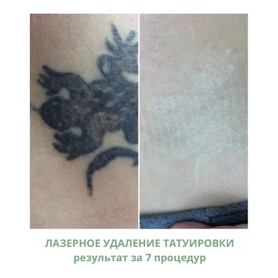 Лазерное удаление татуажа, обучение и оборудование. | Sokolov Laser - Удаление  тату | Дзен