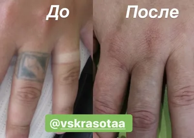 Удаление татуажа — цены в Москве | Клиника Damas Clinic (станция метро  «Таганская»)