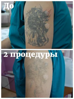 Лазерное удаление татуировок и перманентного макияжа фотографии до и после  в Оренбурге в ЦЭМ \"Вселенная гармонии и красоты\"