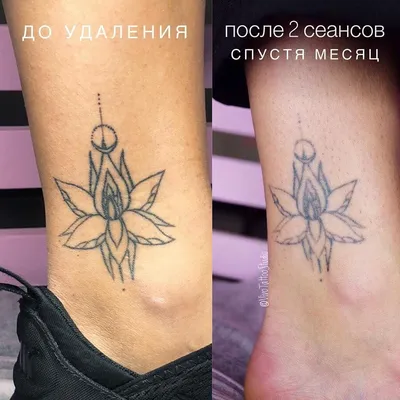 Лазерное удаление татуажа бровей цена в Калининграде