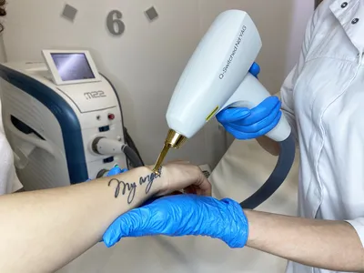 Лазерное удаление тату и татуажа в Днепре : цены и видео-результаты  выведение