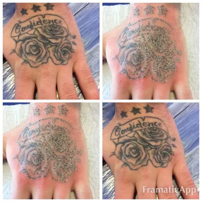Лазерное удаление татуажа - «Удаление очень глубокого татуажа длиною в 11  месяцев после неудачных татуажей... да, их было много» | отзывы